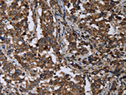 The image on the left is immunohistochemistry of paraffin-embedded Human liver cancer tissue using CSB-PA576137(DNAJC15 Antibody) at dilution 1/40, on the right is treated with fusion protein. (Original magnification: ×200)