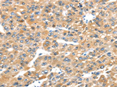 The image on the left is immunohistochemistry of paraffin-embedded Human liver cancer tissue using CSB-PA576176(P2RY2 Antibody) at dilution 1/30, on the right is treated with synthetic peptide. (Original magnification: ×200)