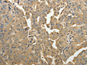The image on the left is immunohistochemistry of paraffin-embedded Human ovarian cancer tissue using CSB-PA576314(PSMD9 Antibody) at dilution 1/50, on the right is treated with fusion protein. (Original magnification: ×200)