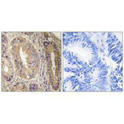 Immunohistochemistry analysis of paraffin-embedded human colon carcinoma tissue, using FAK (Ab-843) antibody.