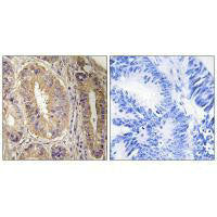 Immunohistochemistry analysis of paraffin-embedded human colon carcinoma tissue, using FAK (Ab-843) antibody.