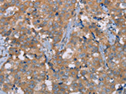 The image on the left is immunohistochemistry of paraffin-embedded Human breast cancer tissue using CSB-PA576563(NRG3 Antibody) at dilution 1/30, on the right is treated with synthetic peptide. (Original magnification: ×200)