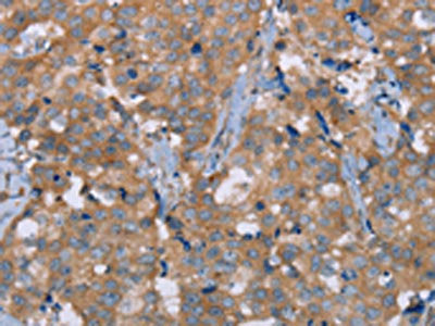 The image on the left is immunohistochemistry of paraffin-embedded Human breast cancer tissue using CSB-PA576563(NRG3 Antibody) at dilution 1/30, on the right is treated with synthetic peptide. (Original magnification: ×200)