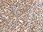 The image on the left is immunohistochemistry of paraffin-embedded Human prostate cancer tissue using CSB-PA576683(RGS1 Antibody) at dilution 1/20, on the right is treated with fusion protein. (Original magnification: ×200)