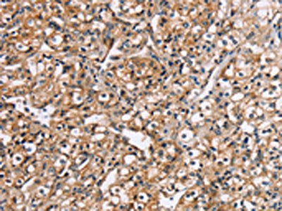 The image on the left is immunohistochemistry of paraffin-embedded Human prostate cancer tissue using CSB-PA576683(RGS1 Antibody) at dilution 1/20, on the right is treated with fusion protein. (Original magnification: ×200)