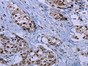 The image on the left is immunohistochemistry of paraffin-embedded Human breast cancer tissue using CSB-PA576712(ID3 Antibody) at dilution 1/40, on the right is treated with synthetic peptide. (Original magnification: ×200)