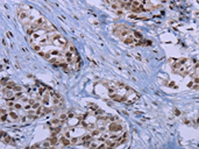 The image on the left is immunohistochemistry of paraffin-embedded Human breast cancer tissue using CSB-PA576712(ID3 Antibody) at dilution 1/40, on the right is treated with synthetic peptide. (Original magnification: ×200)