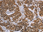 The image on the left is immunohistochemistry of paraffin-embedded Human cervical cancer tissue using CSB-PA576836(CCL21 Antibody) at dilution 1/40, on the right is treated with fusion protein. (Original magnification: ×200)