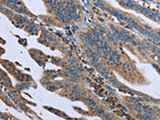 The image on the left is immunohistochemistry of paraffin-embedded Human gastic cancer tissue using CSB-PA576871(GNAI3 Antibody) at dilution 1/40, on the right is treated with fusion protein. (Original magnification: ×200)