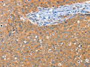 The image on the left is immunohistochemistry of paraffin-embedded Human cervical cancer tissue using CSB-PA577006(ACY3 Antibody) at dilution 1/25, on the right is treated with fusion protein. (Original magnification: ×200)