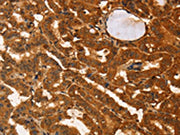 The image on the left is immunohistochemistry of paraffin-embedded Human thyroid cancer tissue using CSB-PA577111(IKZF3 Antibody) at dilution 1/60, on the right is treated with fusion protein. (Original magnification: ×200)
