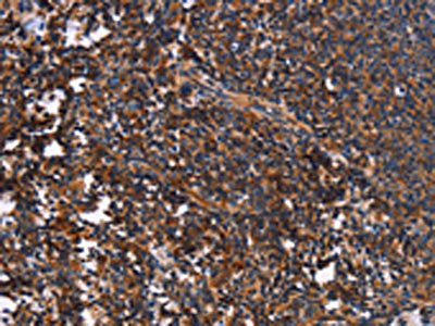 The image on the left is immunohistochemistry of paraffin-embedded Human tonsil tissue using CSB-PA577153(SYT4 Antibody) at dilution 1/60, on the right is treated with fusion protein. (Original magnification: ×200)