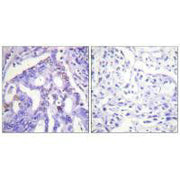 Immunohistochemistry analysis of paraffin-embedded human lung carcinoma tissue using PIAS4 antibody.