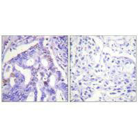Immunohistochemistry analysis of paraffin-embedded human lung carcinoma tissue using PIAS4 antibody.