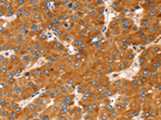 The image on the left is immunohistochemistry of paraffin-embedded Human liver cancer tissue using CSB-PA577196(SLC27A2 Antibody) at dilution 1/20, on the right is treated with fusion protein. (Original magnification: ×200)