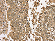 The image on the left is immunohistochemistry of paraffin-embedded Human lung cancer tissue using CSB-PA577486(TGM6 Antibody) at dilution 1/35, on the right is treated with synthetic peptide. (Original magnification: ×200)