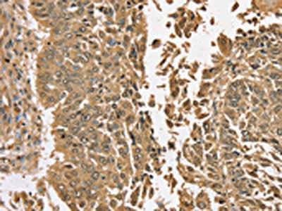 The image on the left is immunohistochemistry of paraffin-embedded Human lung cancer tissue using CSB-PA577486(TGM6 Antibody) at dilution 1/35, on the right is treated with synthetic peptide. (Original magnification: ×200)