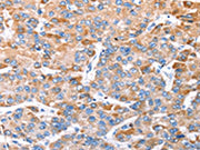 The image on the left is immunohistochemistry of paraffin-embedded Human liver cancer tissue using CSB-PA577609(TRIM14 Antibody) at dilution 1/35, on the right is treated with synthetic peptide. (Original magnification: ×200)