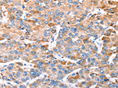 The image on the left is immunohistochemistry of paraffin-embedded Human liver cancer tissue using CSB-PA577609(TRIM14 Antibody) at dilution 1/35, on the right is treated with synthetic peptide. (Original magnification: ×200)