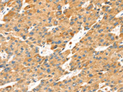 The image on the left is immunohistochemistry of paraffin-embedded Human liver cancer tissue using CSB-PA577745(TNFSF15 Antibody) at dilution 1/30, on the right is treated with synthetic peptide. (Original magnification: ×200)
