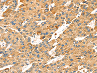 The image on the left is immunohistochemistry of paraffin-embedded Human liver cancer tissue using CSB-PA577745(TNFSF15 Antibody) at dilution 1/30, on the right is treated with synthetic peptide. (Original magnification: ×200)