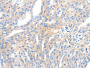 The image on the left is immunohistochemistry of paraffin-embedded Human thyroid cancer tissue using CSB-PA577841(NFATC2 Antibody) at dilution 1/30, on the right is treated with synthetic peptide. (Original magnification: ×200)