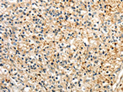 The image on the left is immunohistochemistry of paraffin-embedded Human prostate cancer tissue using CSB-PA578011(Rab17 Antibody) at dilution 1/30, on the right is treated with synthetic peptide. (Original magnification: ×200)