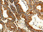 The image on the left is immunohistochemistry of paraffin-embedded Human colon cancer tissue using CSB-PA578056(MAP1LC3A Antibody) at dilution 1/15, on the right is treated with fusion protein. (Original magnification: ×200)