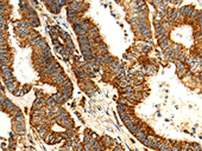 The image on the left is immunohistochemistry of paraffin-embedded Human colon cancer tissue using CSB-PA578056(MAP1LC3A Antibody) at dilution 1/15, on the right is treated with fusion protein. (Original magnification: ×200)