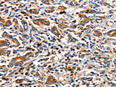 The image on the left is immunohistochemistry of paraffin-embedded Human gastic cancer tissue using CSB-PA578073(CLDN5 Antibody) at dilution 1/10, on the right is treated with synthetic peptide. (Original magnification: ×200)