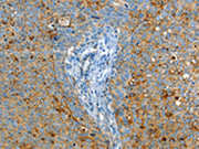 The image on the left is immunohistochemistry of paraffin-embedded Human cervical cancer tissue using CSB-PA578122(ASAH1 Antibody) at dilution 1/50, on the right is treated with fusion protein. (Original magnification: ×200)