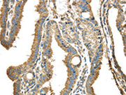 The image on the left is immunohistochemistry of paraffin-embedded Human thyroid cancer tissue using CSB-PA578283(NME2 Antibody) at dilution 1/40, on the right is treated with synthetic peptide. (Original magnification: ×200)