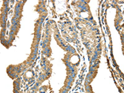 The image on the left is immunohistochemistry of paraffin-embedded Human thyroid cancer tissue using CSB-PA578283(NME2 Antibody) at dilution 1/40, on the right is treated with synthetic peptide. (Original magnification: ×200)