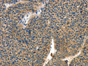 The image on the left is immunohistochemistry of paraffin-embedded Human liver cancer tissue using CSB-PA578311(COL4A2 Antibody) at dilution 1/70, on the right is treated with synthetic peptide. (Original magnification: ×200)