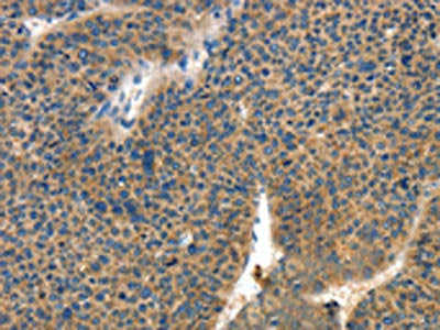 The image on the left is immunohistochemistry of paraffin-embedded Human liver cancer tissue using CSB-PA578311(COL4A2 Antibody) at dilution 1/70, on the right is treated with synthetic peptide. (Original magnification: ×200)