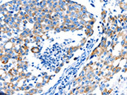 The image on the left is immunohistochemistry of paraffin-embedded Human breast cancer tissue using CSB-PA578328(POMC Antibody) at dilution 1/30, on the right is treated with synthetic peptide. (Original magnification: ×200)