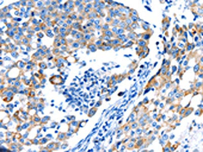The image on the left is immunohistochemistry of paraffin-embedded Human breast cancer tissue using CSB-PA578328(POMC Antibody) at dilution 1/30, on the right is treated with synthetic peptide. (Original magnification: ×200)