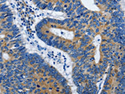 The image on the left is immunohistochemistry of paraffin-embedded Human colon cancer tissue using CSB-PA578519(BPIFB3 Antibody) at dilution 1/50, on the right is treated with synthetic peptide. (Original magnification: ×200)
