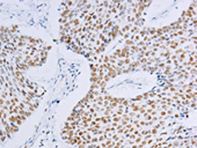 The image on the left is immunohistochemistry of paraffin-embedded Human lung cancer tissue using CSB-PA578532(MCM2 Antibody) at dilution 1/20, on the right is treated with fusion protein. (Original magnification: ×200)
