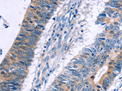 The image on the left is immunohistochemistry of paraffin-embedded Human colon cancer tissue using CSB-PA578770(ERBB3 Antibody) at dilution 1/20, on the right is treated with fusion protein. (Original magnification: ×200)