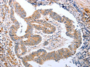 The image on the left is immunohistochemistry of paraffin-embedded Human colon cancer tissue using CSB-PA578796(CDK20 Antibody) at dilution 1/15, on the right is treated with fusion protein. (Original magnification: ×200)