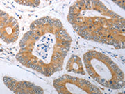 The image on the left is immunohistochemistry of paraffin-embedded Human colon cancer tissue using CSB-PA579163(RBMS3 Antibody) at dilution 1/25, on the right is treated with synthetic peptide. (Original magnification: ×200)