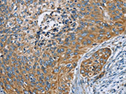 The image on the left is immunohistochemistry of paraffin-embedded Human cervical cancer tissue using CSB-PA579260(ZMYND11 Antibody) at dilution 1/70, on the right is treated with fusion protein. (Original magnification: ×200)