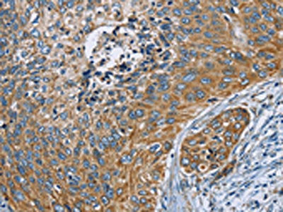 The image on the left is immunohistochemistry of paraffin-embedded Human cervical cancer tissue using CSB-PA579260(ZMYND11 Antibody) at dilution 1/70, on the right is treated with fusion protein. (Original magnification: ×200)