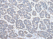 The image on the left is immunohistochemistry of paraffin-embedded Human esophagus cancer tissue using CSB-PA579290(COX4I1 Antibody) at dilution 1/25, on the right is treated with synthetic peptide. (Original magnification: ×200)