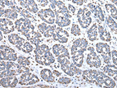 The image on the left is immunohistochemistry of paraffin-embedded Human esophagus cancer tissue using CSB-PA579290(COX4I1 Antibody) at dilution 1/25, on the right is treated with synthetic peptide. (Original magnification: ×200)