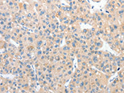 The image on the left is immunohistochemistry of paraffin-embedded Human liver cancer tissue using CSB-PA579544(RPN1 Antibody) at dilution 1/25, on the right is treated with fusion protein. (Original magnification: ×200)