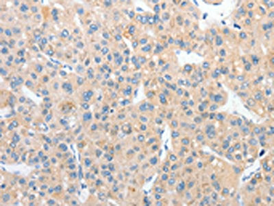 The image on the left is immunohistochemistry of paraffin-embedded Human liver cancer tissue using CSB-PA579544(RPN1 Antibody) at dilution 1/25, on the right is treated with fusion protein. (Original magnification: ×200)