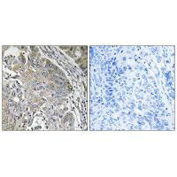 Immunohistochemistry analysis of paraffin-embedded human lung carcinoma tissue using SPINK6 antibody.