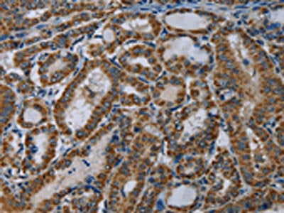 The image on the left is immunohistochemistry of paraffin-embedded Human thyroid cancer tissue using CSB-PA579687(NDUFA5 Antibody) at dilution 1/60, on the right is treated with fusion protein. (Original magnification: ×200)